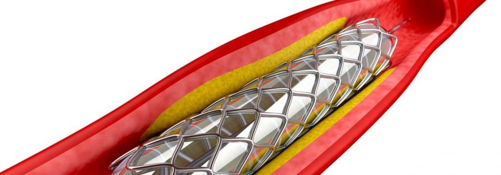 Image of E&L testing on angioplasty medical device. Jordi Labs specializes in Extractables & Leachables (E&L) testing for medical devices.