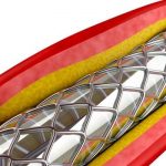 Image of E&L testing on angioplasty medical device. Jordi Labs specializes in Extractables & Leachables (E&L) testing for medical devices.